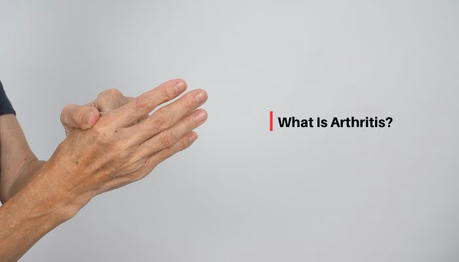 How to Prevent Arthritis: Expert Insights and Proven Strategies